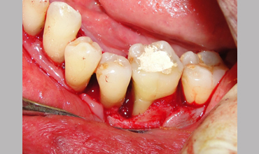 Preventative dentistry treatment in Anand
                        